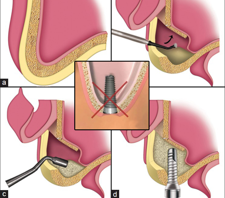 Thông tin về kỹ thuật nâng xoang hàm trong cấy ghép implant 2