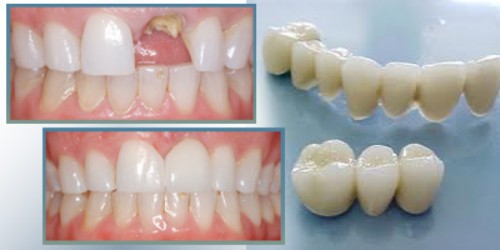 Kỹ thuật trồng răng giả cố định mang lại nụ cười tự tin cho mọi người *