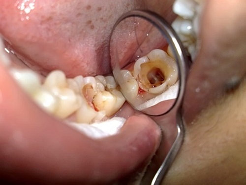 Áp xe răng là gì? Tình trạng áp xe răng khôn	 1