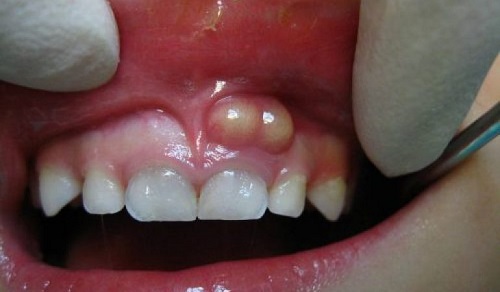  Bị áp xe răng có nguy hiểm không? 1