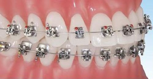 Chi phí niềng răng mắc cài inox bao nhiêu? 1