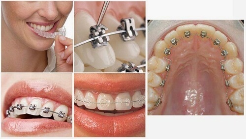 Niềng răng 1 hàm có đau không? Hiệu quả ra sao