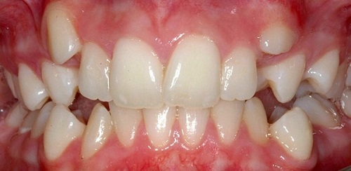 Niềng răng khểnh mất bao lâu là răng đều lại?