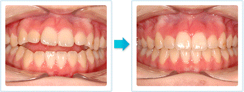 Phương pháp điều trị niềng răng khớp cắn hở hiệu quả