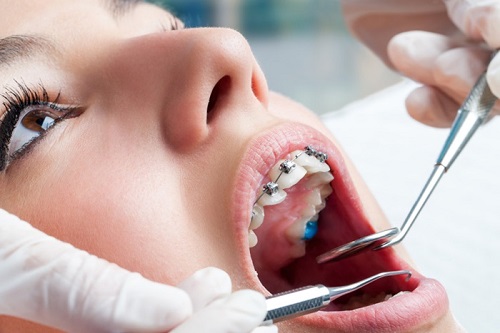 Dịch vụ niềng răng trả góp tphcm có nha khoa nào thực hiện không