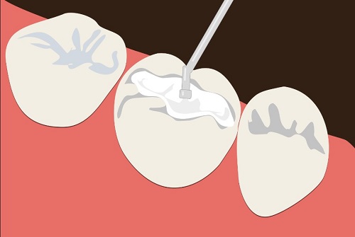 Trám răng mất thời gian bao lâu là xong? 3 điều cần lưu ý sau khi trám răng 1