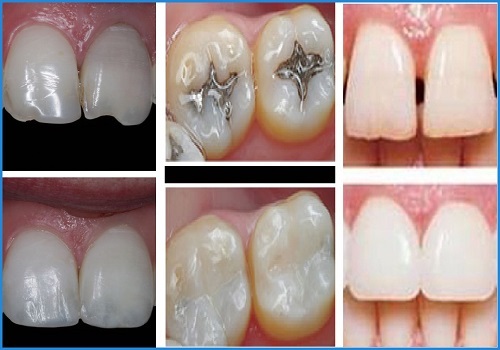 Trám răng mất thời gian bao lâu là xong? 3 điều cần lưu ý sau khi trám răng 3