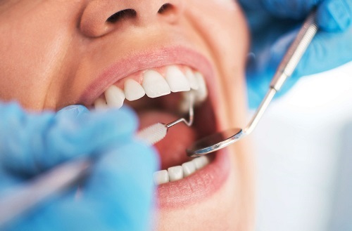 Niềng răng bị lòi chân răng - Khắc phục từ nha khoa