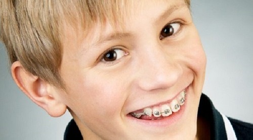 Niềng răng hàm trên mất bao lâu là có kết quả?