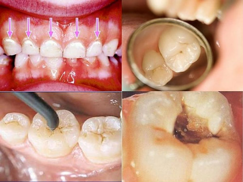 Trám răng không nên ăn gì để có kết quả tốt? 1