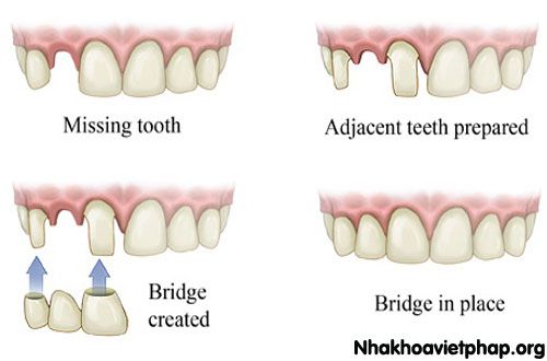 Trồng răng bằng cầu răng thực hiện như thế nào? 3