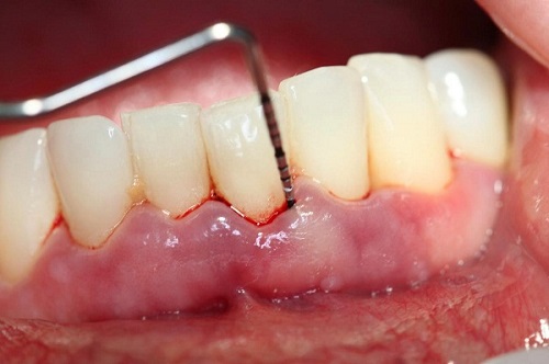 Lắp răng sứ bị sưng lợi - Nguyên nhân và cách khắc phục