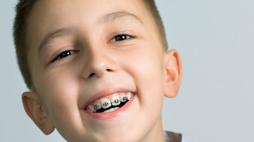 Nguyên nhân niềng răng làm răng lung lay là gì?