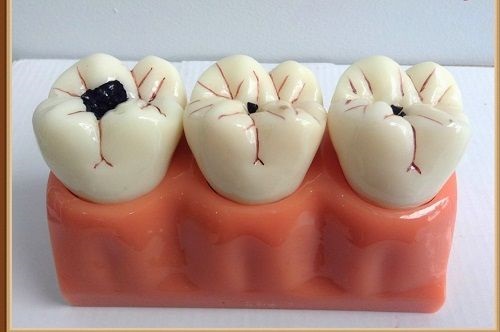 Răng sứ có bị sâu không sau khi bọc răng?