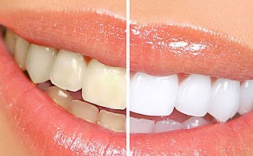 Tác hại của việc tẩy trắng răng là gì? Nha khoa chia sẻ 1