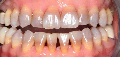 Tác hại của việc tẩy trắng răng là gì? Nha khoa chia sẻ 2