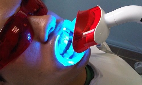 Thực hư tẩy trắng răng bằng đèn plasma có hại không 3