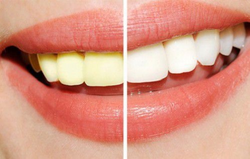 Tẩy trắng răng brite smile hiệu quả ra sao? 3