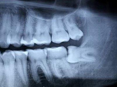 Chụp X quang răng khôn bao nhiêu tiền? 2