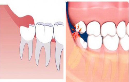 Cách điều trị sưng lợi ở răng khôn - Chấm dứt hiệu quả 2