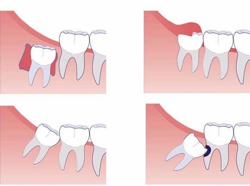 Cách điều trị sưng lợi ở răng khôn - Chấm dứt hiệu quả 3