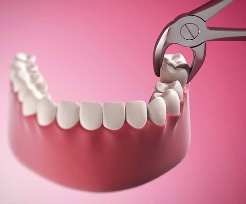 Viêm ổ răng khôn - Nguyên nhân và cách ngăn ngừa hiệu quả 2