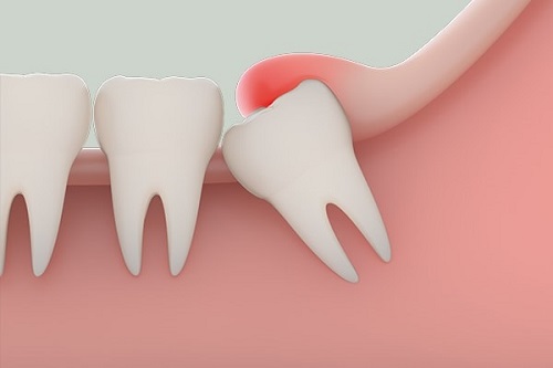 Nhổ 2 răng khôn hàm dưới cùng lúc có nên không? 2