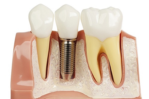 Trồng răng giả có lâu không? Tìm hiểu quy trình để biết chi tiết 2