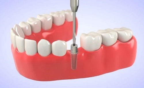 Trồng răng giả có lâu không? Tìm hiểu quy trình để biết chi tiết 4
