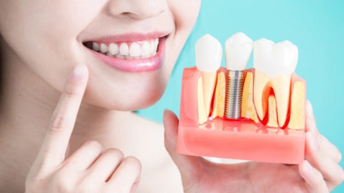 Trồng răng kiêng ăn gì? Tư vấn từ nha khoa 1