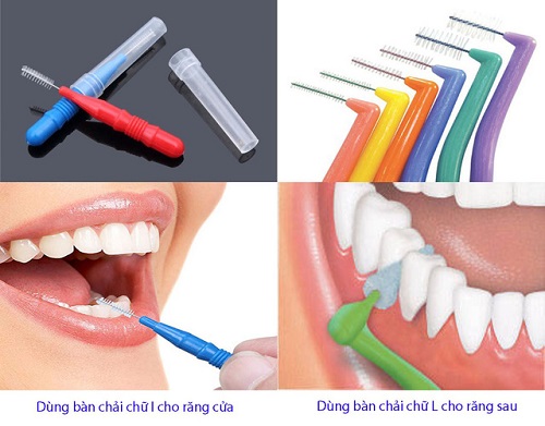 Niềng răng nên dùng bàn chải gì để vệ sinh hiệu quả? 4
