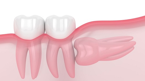 Răng khôn dị dạng là như thế nào? 3