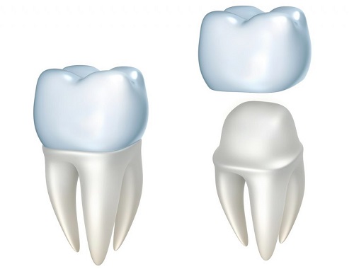 Bọc răng sứ cho răng hàm sâu hiệu quả không tái phát 2