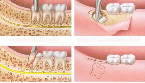 Răng khôn bị sâu có nên nhổ không? Bác sĩ tư vấn 3
