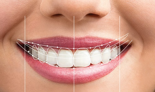 Bọc răng sứ bị cộm - Cách khắc phục hiệu quả 1