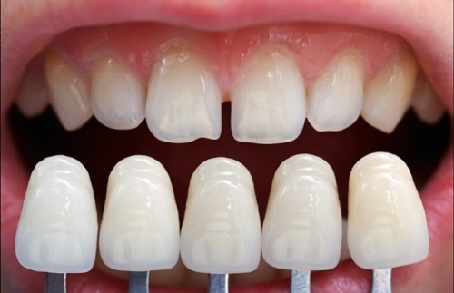 Bọc răng sứ không cần mài răng - Có tốt không? 2
