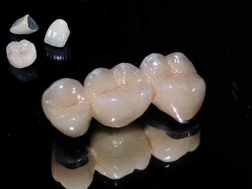 Có nên trồng răng sứ titan - Nha khoa giải đáp 1