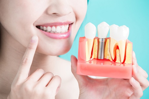 Trồng răng khểnh có đau không? Phương pháp phù hợp 2