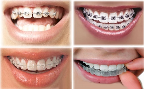 Niềng răng lúc nào đau nhất? Các giai đoạn niềng răng 1