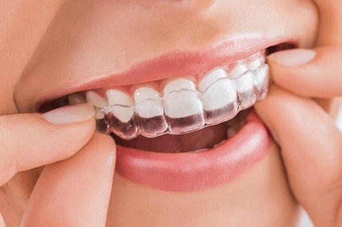 Dụng cụ niềng răng tại nhà có tốt không? Tìm hiểu 3
