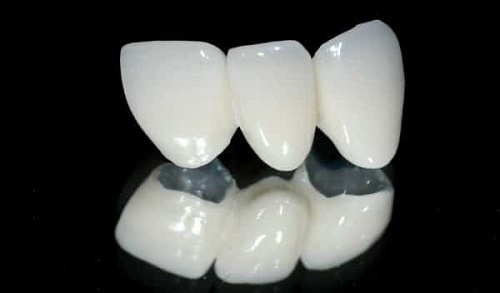 Răng sứ titan có bị đen không? Tìm hiểu về răng sứ 2